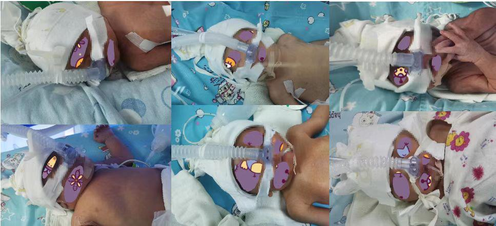 无创辅助通气是什么无创通气技术——新生儿急危重症抢救的重要手段_https://www.jmylbn.com_新闻资讯_第2张