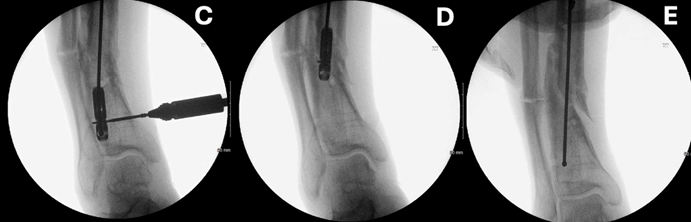 断裂髓内钉取出术--橄榄头导丝加小螺钉的妙用