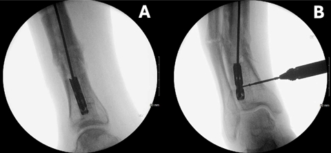 断裂髓内钉取出术--橄榄头导丝加小螺钉的妙用