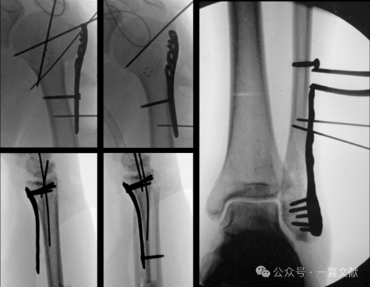 术中骨折复位技巧之：钥匙、门与拼图