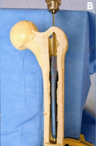 断裂髓内钉取出术--橄榄头导丝加小螺钉的妙用