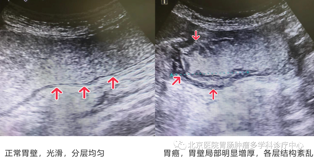 胃造影用的是什么机子特殊人群的舒适检查之胃超声造影_https://www.jmylbn.com_新闻资讯_第2张