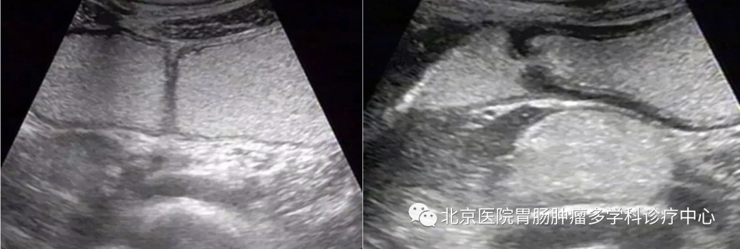 胃造影用的是什么机子特殊人群的舒适检查之胃超声造影_https://www.jmylbn.com_新闻资讯_第1张