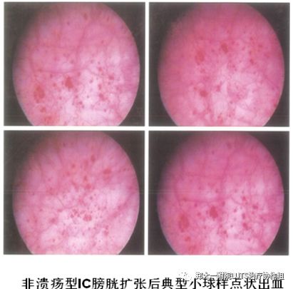 间质性膀胱炎的处理应用抗生素无效以下腹部疼痛为特征