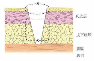 医生为什么缝合不用细线美容缝合就是“小针细线”吗？——天津市南开医院整形修复外科医生有话说【健康我知道】_https://www.jmylbn.com_新闻资讯_第2张