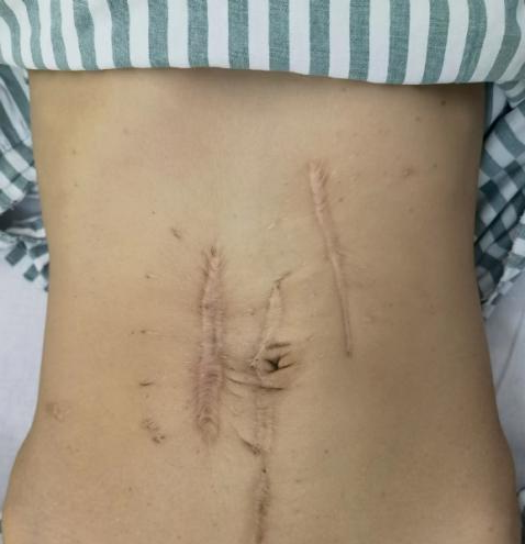 手术拉链怎么拆前沿突破 ｜ 中山医院内镜团队再闯禁区，巧用小肠镜切除巨大息肉，解除“拉链腹”患者肠套叠之苦_https://www.jmylbn.com_新闻资讯_第2张