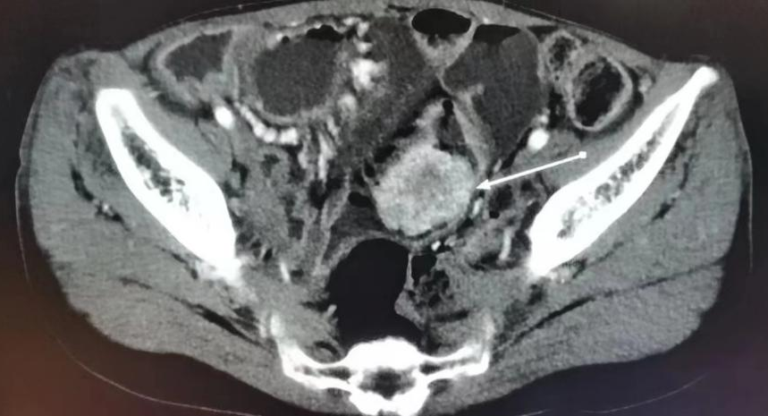 手术拉链怎么拆前沿突破 ｜ 中山医院内镜团队再闯禁区，巧用小肠镜切除巨大息肉，解除“拉链腹”患者肠套叠之苦_https://www.jmylbn.com_新闻资讯_第4张