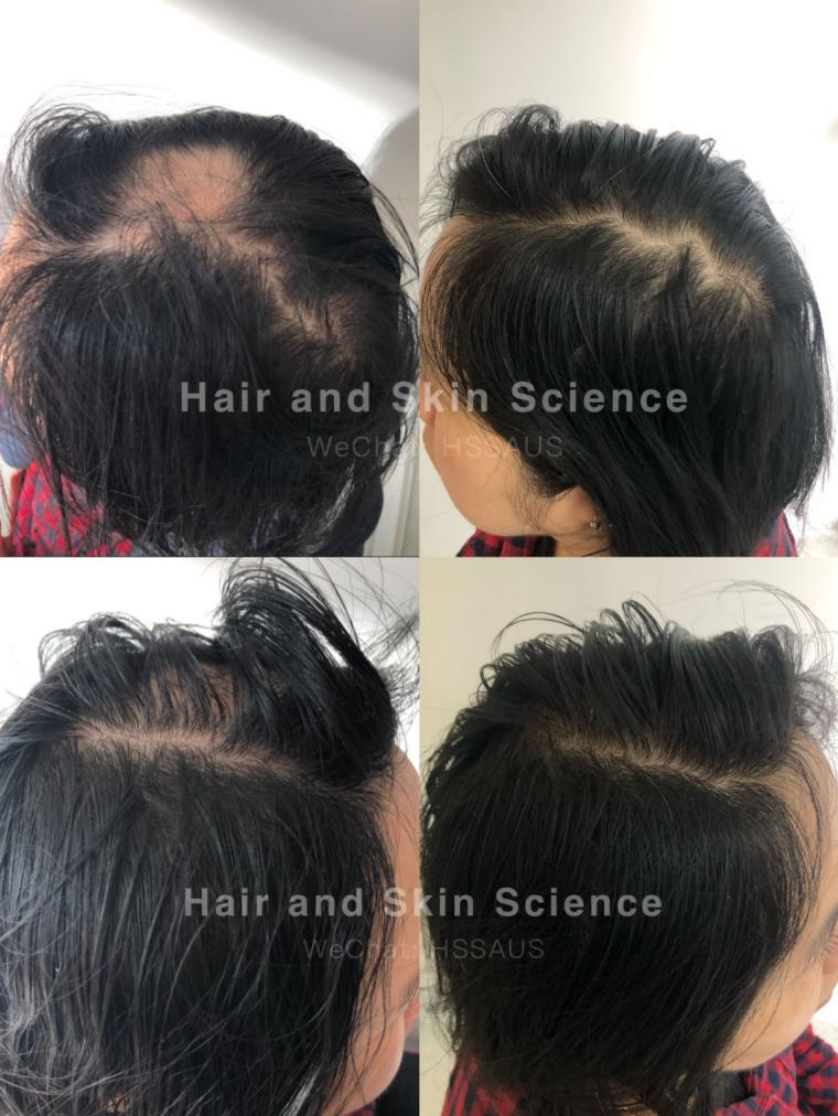 刚刚！确认了：珀斯华人们脱发、烂脸终于有破解方法啦！年度最优惠&免费面诊，帮您一键颜值回春（组图） - 18