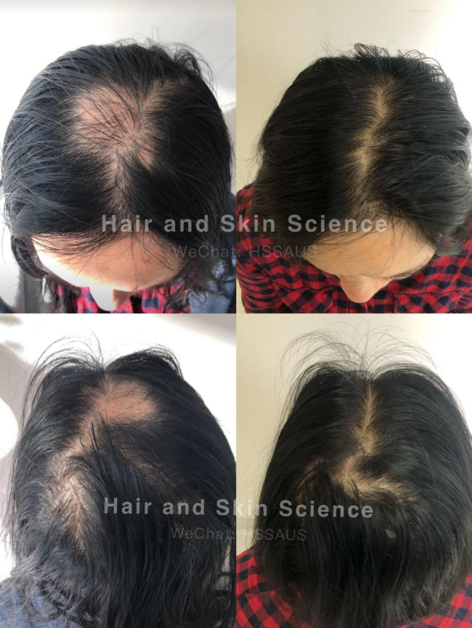 刚刚！确认了：珀斯华人们脱发、烂脸终于有破解方法啦！年度最优惠&免费面诊，帮您一键颜值回春（组图） - 19