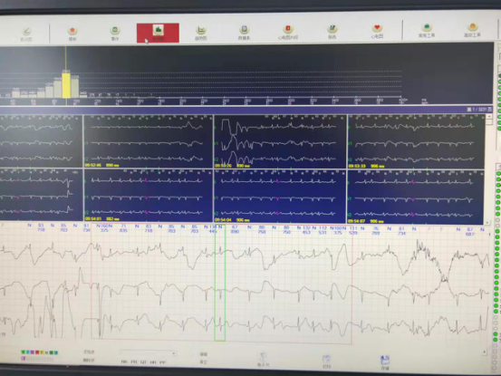 动态心电图自己怎么记录24小时动态心电图，做还是不做？_https://www.jmylbn.com_新闻资讯_第5张