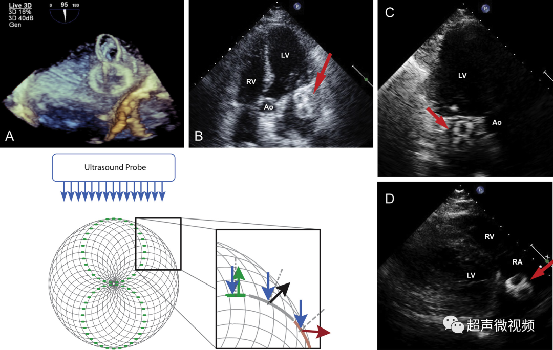 彩超伪像是什么心脏超声伪像有哪些？如何识别它们？_https://www.jmylbn.com_新闻资讯_第31张