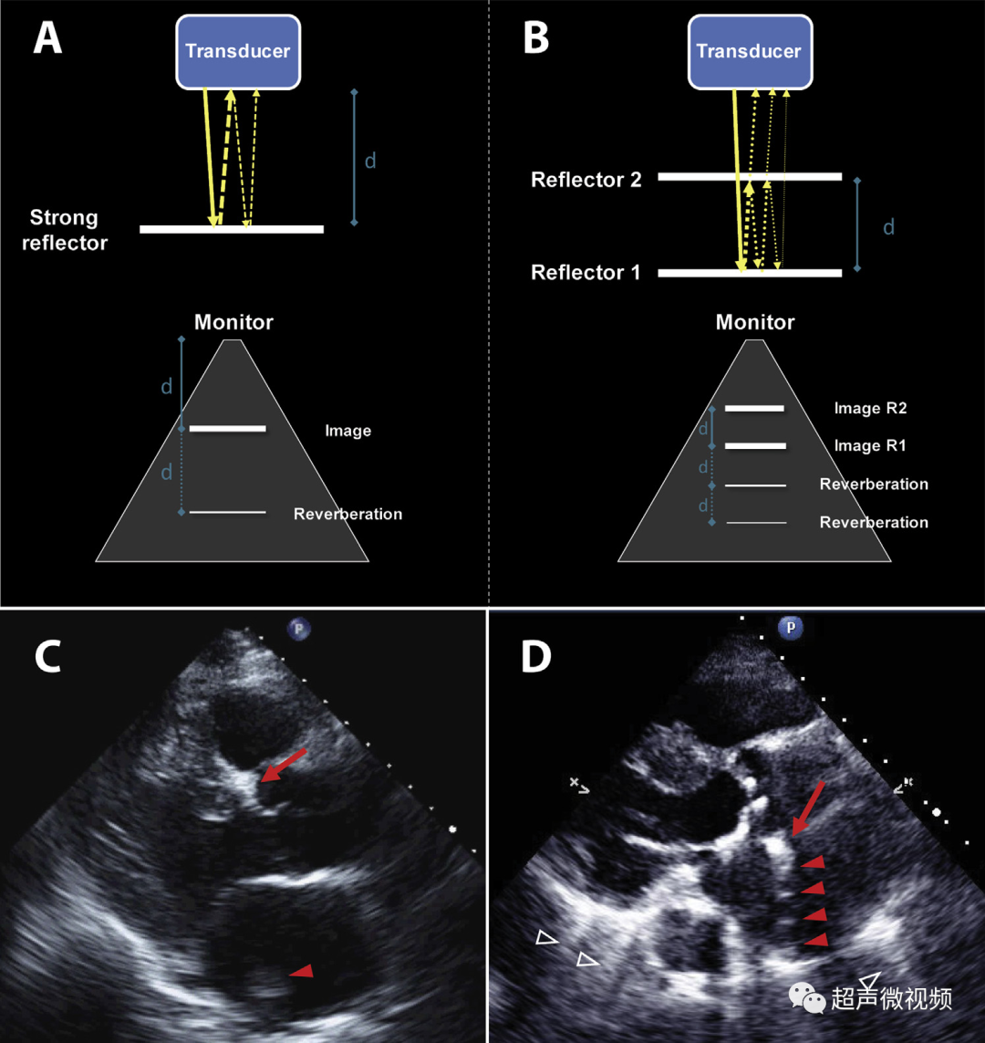 彩超伪像是什么心脏超声伪像有哪些？如何识别它们？_https://www.jmylbn.com_新闻资讯_第5张