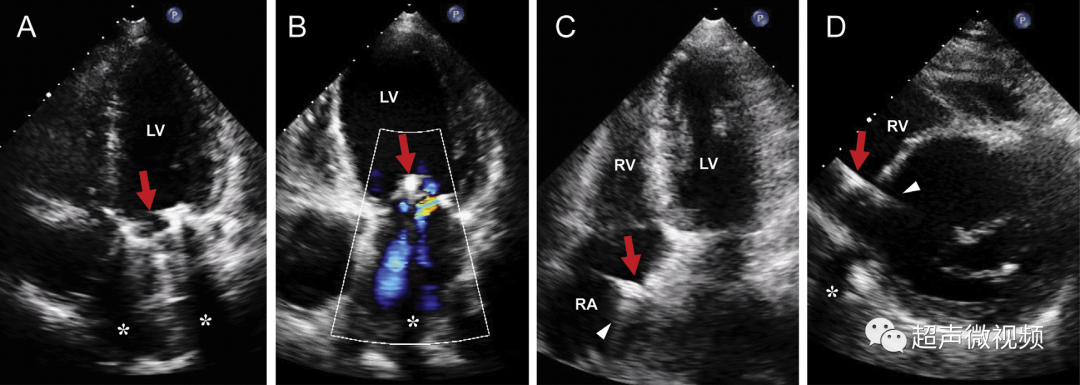 彩超伪像是什么心脏超声伪像有哪些？如何识别它们？_https://www.jmylbn.com_新闻资讯_第27张
