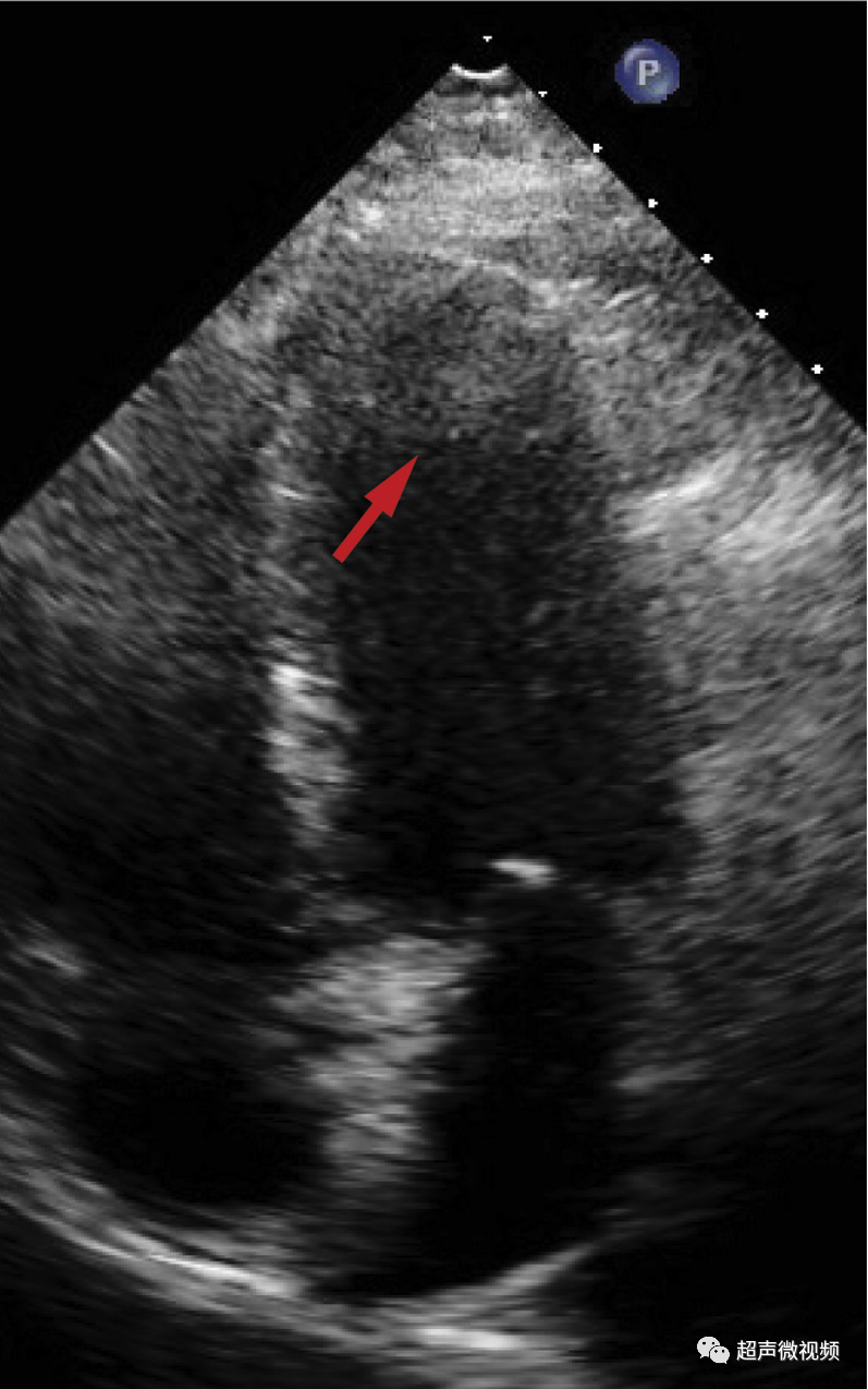 彩超伪像是什么心脏超声伪像有哪些？如何识别它们？_https://www.jmylbn.com_新闻资讯_第24张