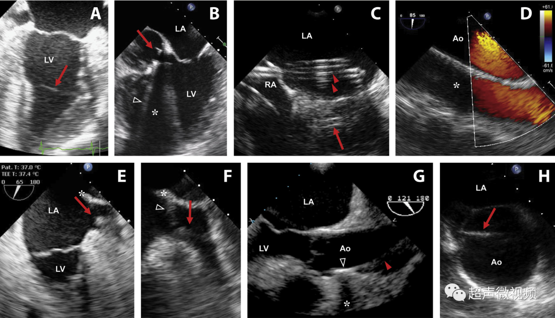 彩超伪像是什么心脏超声伪像有哪些？如何识别它们？_https://www.jmylbn.com_新闻资讯_第35张