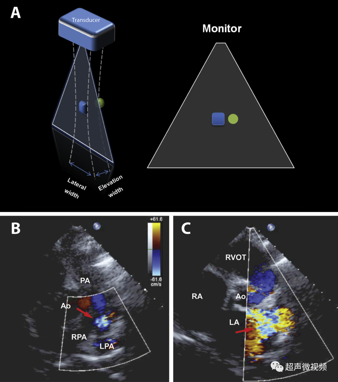 彩超伪像是什么心脏超声伪像有哪些？如何识别它们？_https://www.jmylbn.com_新闻资讯_第22张