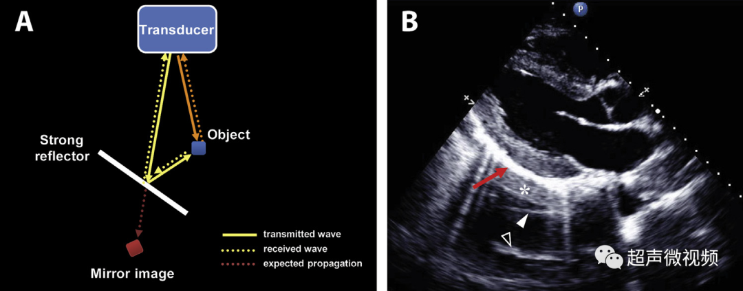 彩超伪像是什么心脏超声伪像有哪些？如何识别它们？_https://www.jmylbn.com_新闻资讯_第10张