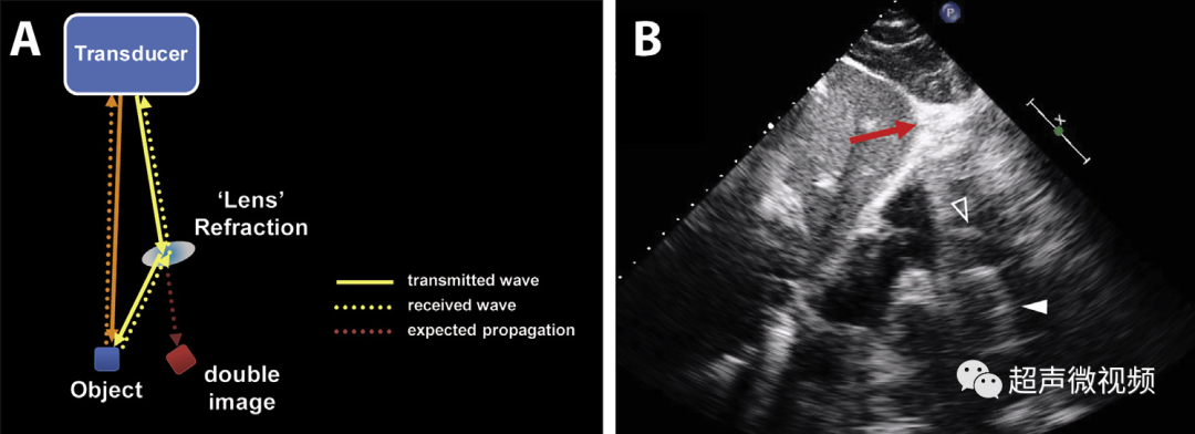 彩超伪像是什么心脏超声伪像有哪些？如何识别它们？_https://www.jmylbn.com_新闻资讯_第14张