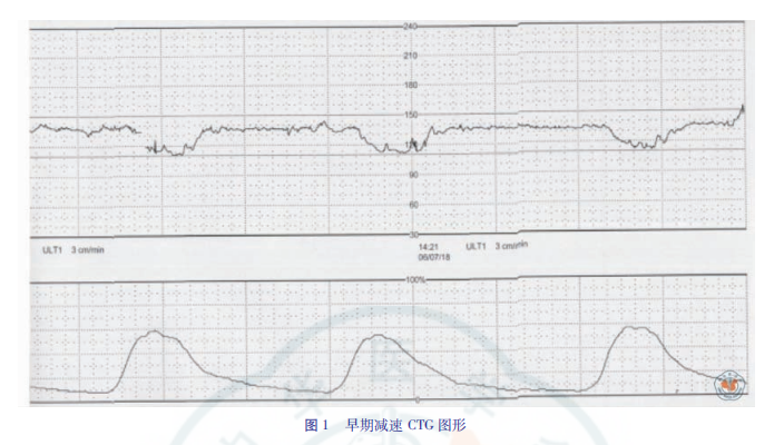 什么是胎儿监护异常胎心监护及脐带血pH值与新生儿缺血缺氧性脑损伤_https://www.jmylbn.com_新闻资讯_第9张