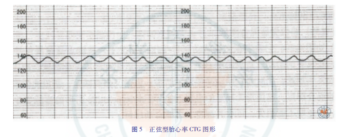 什么是胎儿监护异常胎心监护及脐带血pH值与新生儿缺血缺氧性脑损伤_https://www.jmylbn.com_新闻资讯_第19张