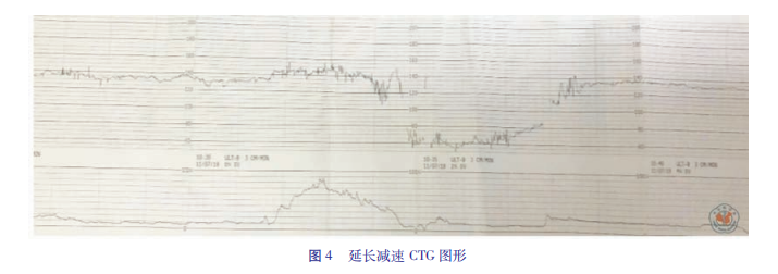 什么是胎儿监护异常胎心监护及脐带血pH值与新生儿缺血缺氧性脑损伤_https://www.jmylbn.com_新闻资讯_第17张