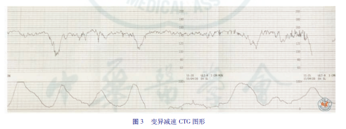 什么是胎儿监护异常胎心监护及脐带血pH值与新生儿缺血缺氧性脑损伤_https://www.jmylbn.com_新闻资讯_第14张