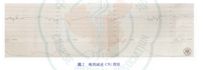 什么是胎儿监护异常胎心监护及脐带血pH值与新生儿缺血缺氧性脑损伤_https://www.jmylbn.com_新闻资讯_第12张