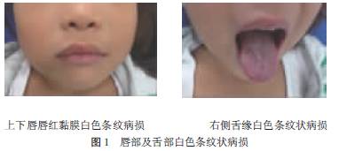 儿童口腔扁平苔藓病例报告2例
