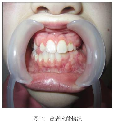 下颌骨软骨黏液样纤维瘤1例