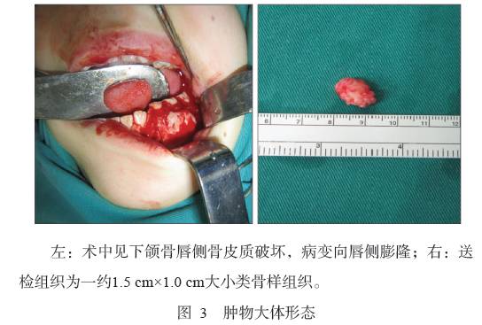 下颌骨软骨黏液样纤维瘤1例