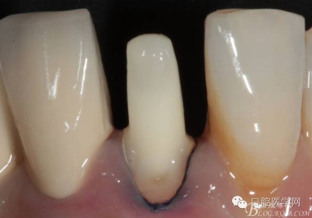 三例下前牙冠修复的回顾与反思