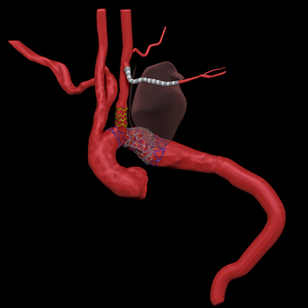gore医疗怎么样「胸有乾坤」国际首例 微创杂交技术治疗巨大左锁骨下动脉瘤合并主动脉缩窄Larsen综合症患者_https://www.jmylbn.com_新闻资讯_第16张