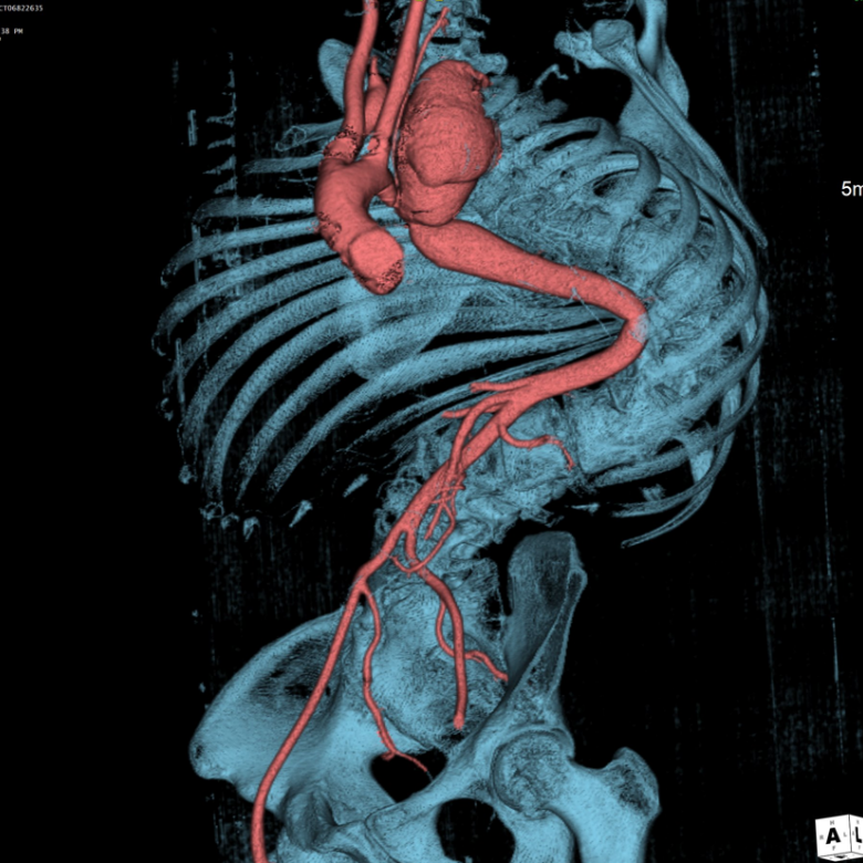 gore医疗怎么样「胸有乾坤」国际首例 微创杂交技术治疗巨大左锁骨下动脉瘤合并主动脉缩窄Larsen综合症患者_https://www.jmylbn.com_新闻资讯_第6张