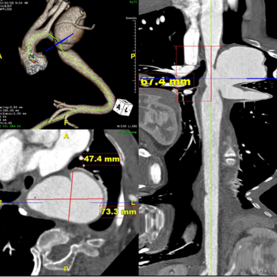 gore医疗怎么样「胸有乾坤」国际首例 微创杂交技术治疗巨大左锁骨下动脉瘤合并主动脉缩窄Larsen综合症患者_https://www.jmylbn.com_新闻资讯_第7张