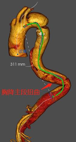 治疗车怎么推「弓部重建直通车」鄂尔多斯市中心医院康巴什部介入科运用Castor®分支型支架联合预开窗技术治疗Stanford B型胸主动夹层_https://www.jmylbn.com_新闻资讯_第5张