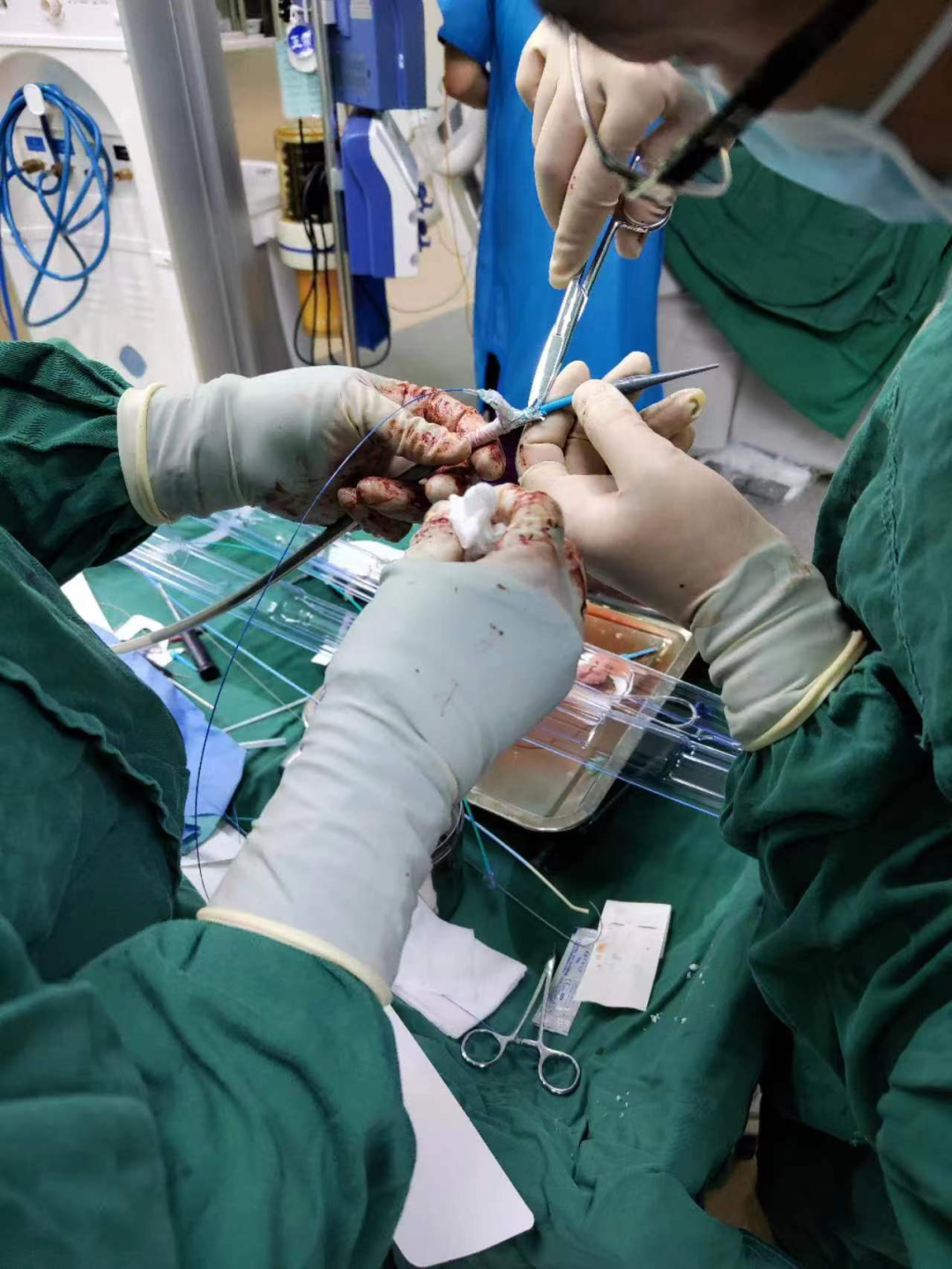 治疗车怎么推「弓部重建直通车」鄂尔多斯市中心医院康巴什部介入科运用Castor®分支型支架联合预开窗技术治疗Stanford B型胸主动夹层_https://www.jmylbn.com_新闻资讯_第7张