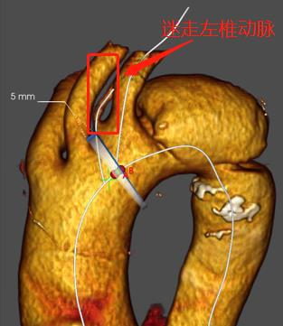 治疗车怎么推「弓部重建直通车」鄂尔多斯市中心医院康巴什部介入科运用Castor®分支型支架联合预开窗技术治疗Stanford B型胸主动夹层_https://www.jmylbn.com_新闻资讯_第4张