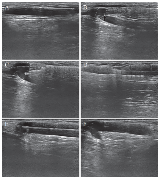 pta在医学上什么意思超声引导下镍钛合金支架植入——动静脉内瘘PTA后复发性狭窄治疗的新曙光_https://www.jmylbn.com_新闻资讯_第3张