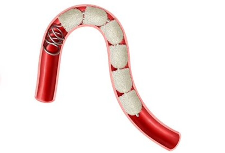 栓塞器材有哪些器械百科丨IMPEDE-FX RapidFill装置_https://www.jmylbn.com_新闻资讯_第18张