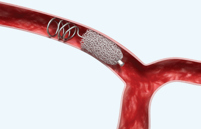 栓塞器材有哪些器械百科丨IMPEDE-FX RapidFill装置_https://www.jmylbn.com_新闻资讯_第13张