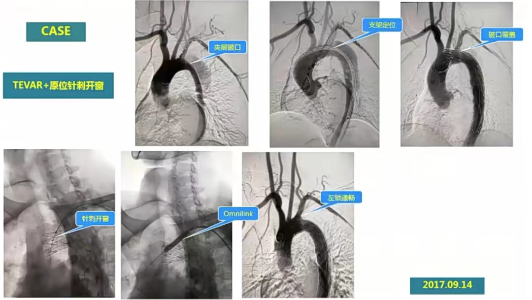 导丝怎么扩精彩荟萃【经典润新-“颈”亦求精】雅培颈动脉专题会@CEC2022_https://www.jmylbn.com_新闻资讯_第11张