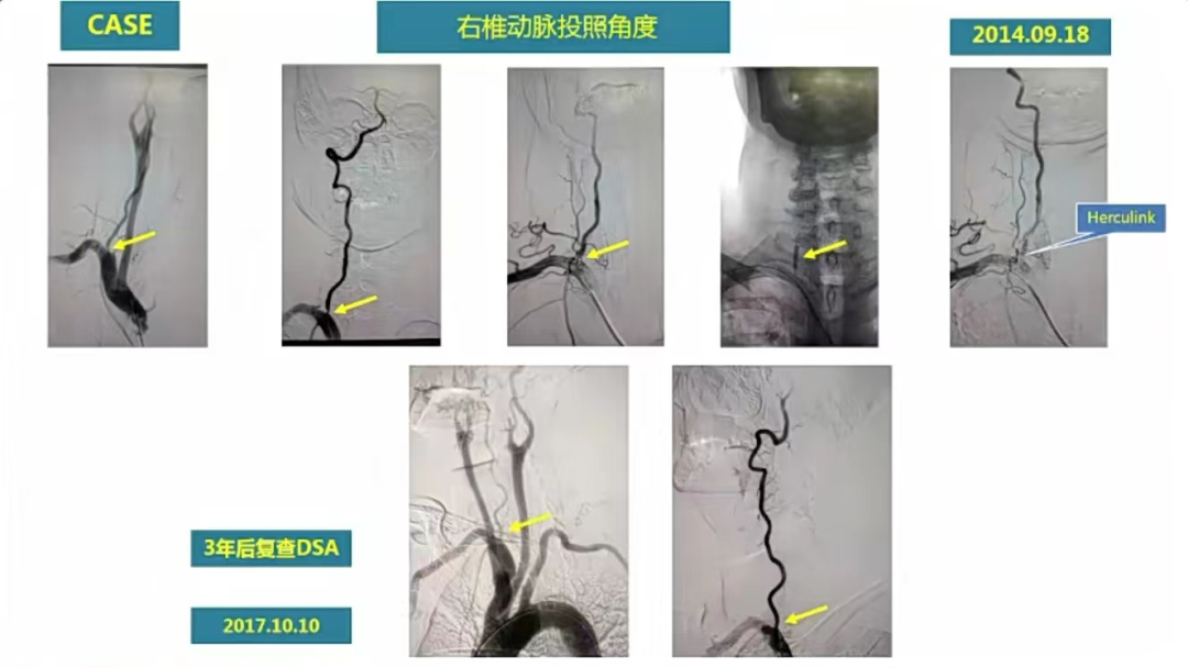 导丝怎么扩精彩荟萃【经典润新-“颈”亦求精】雅培颈动脉专题会@CEC2022_https://www.jmylbn.com_新闻资讯_第13张