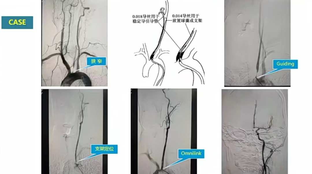 导丝怎么扩精彩荟萃【经典润新-“颈”亦求精】雅培颈动脉专题会@CEC2022_https://www.jmylbn.com_新闻资讯_第12张