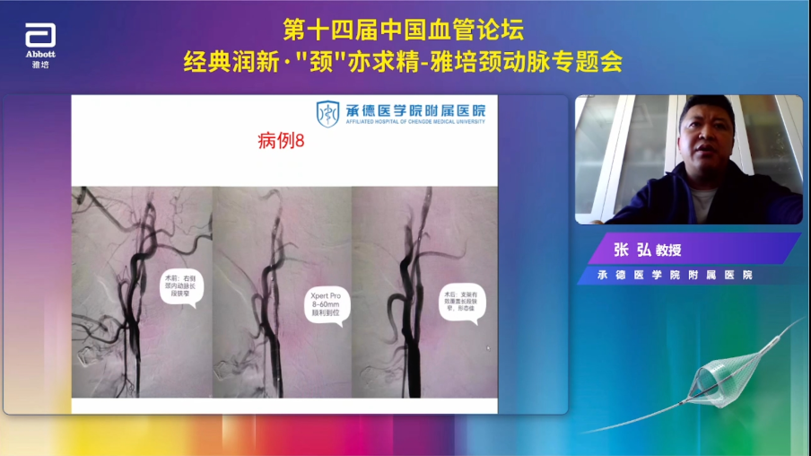 导丝怎么扩精彩荟萃【经典润新-“颈”亦求精】雅培颈动脉专题会@CEC2022_https://www.jmylbn.com_新闻资讯_第9张