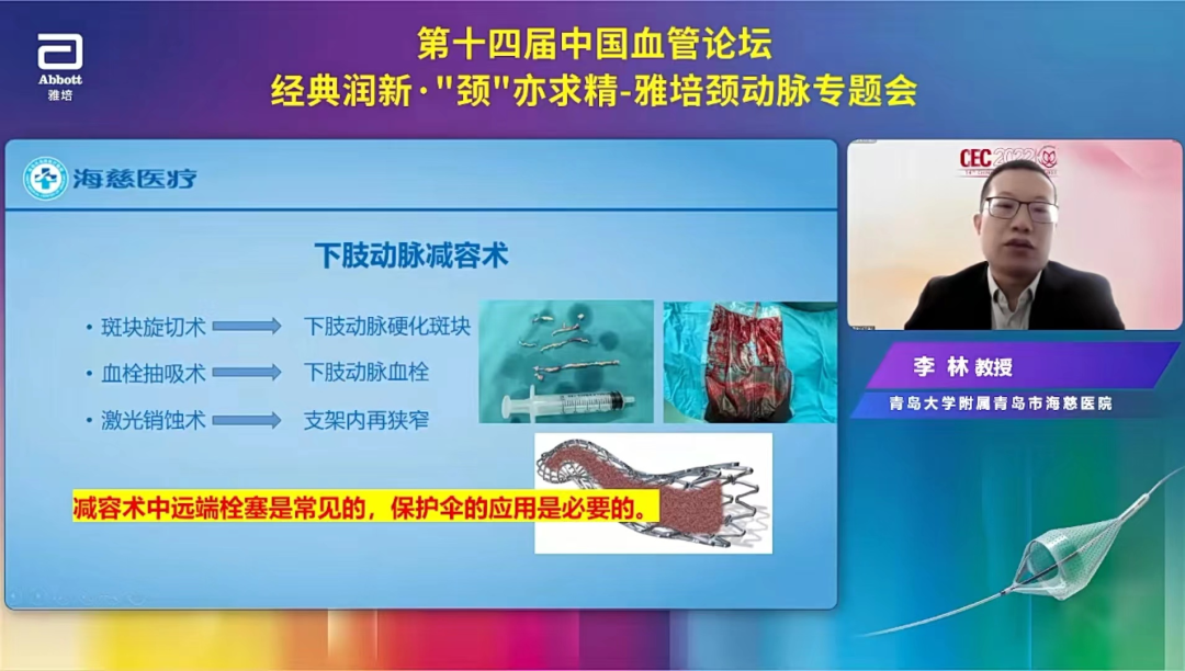 导丝怎么扩精彩荟萃【经典润新-“颈”亦求精】雅培颈动脉专题会@CEC2022_https://www.jmylbn.com_新闻资讯_第16张