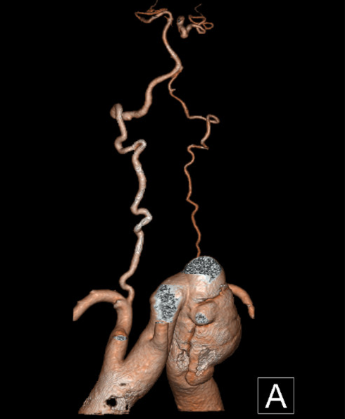 gore医疗怎么样「胸有乾坤」化险为夷，通险畅机——GORE® TAG® 胸主动脉覆膜支架治疗累及异形弓部动脉瘤_https://www.jmylbn.com_新闻资讯_第13张