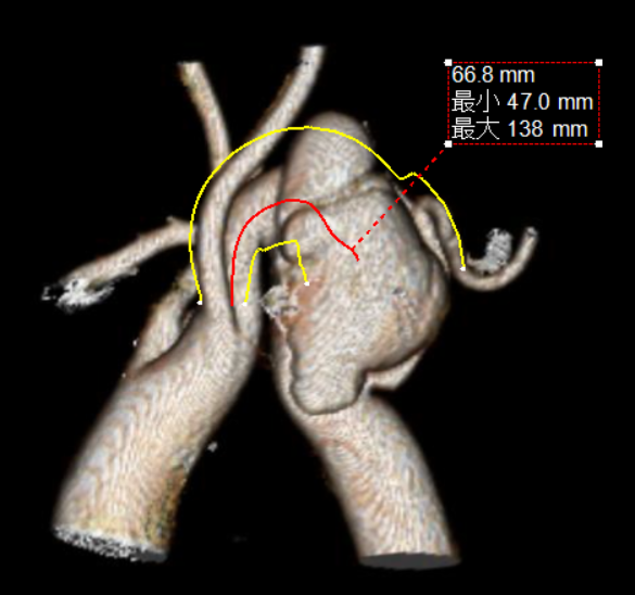 gore医疗怎么样「胸有乾坤」化险为夷，通险畅机——GORE® TAG® 胸主动脉覆膜支架治疗累及异形弓部动脉瘤_https://www.jmylbn.com_新闻资讯_第11张