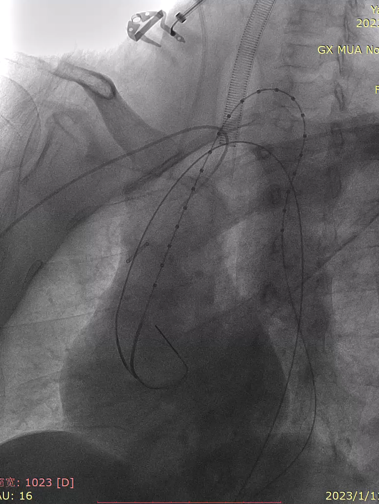 gore医疗怎么样「胸有乾坤」化险为夷，通险畅机——GORE® TAG® 胸主动脉覆膜支架治疗累及异形弓部动脉瘤_https://www.jmylbn.com_新闻资讯_第16张