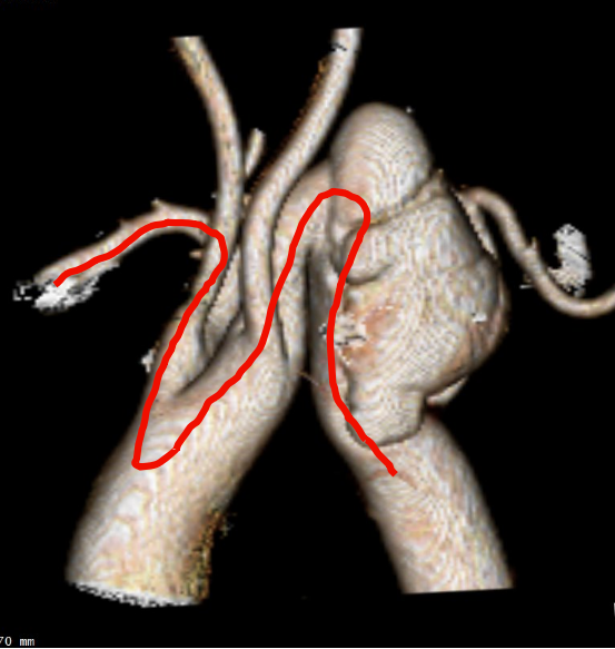 gore医疗怎么样「胸有乾坤」化险为夷，通险畅机——GORE® TAG® 胸主动脉覆膜支架治疗累及异形弓部动脉瘤_https://www.jmylbn.com_新闻资讯_第8张