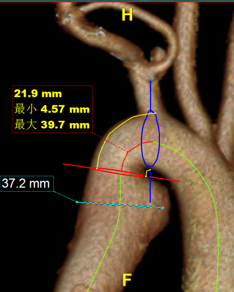 gore医疗怎么样「胸有乾坤」可调可控，从容不迫——GORE® TAG®可主动调控胸主动脉覆膜支架治疗右弓右降伴Kommerell憩室病例_https://www.jmylbn.com_新闻资讯_第10张